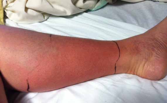 皮膚紅腫熱痛不可忽視　蜂窩性組織炎可能會截肢 
