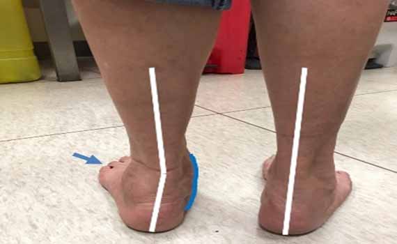 會痛的「後天性」扁平足 醫師教你如何提高警覺