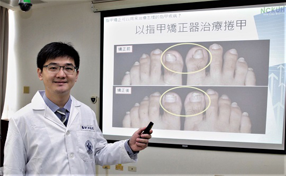 指甲矯正器治捲甲及嵌甲　是手術治療外的新方法 