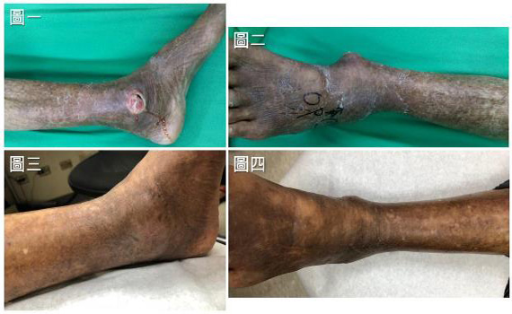 減少截肢風險!糖尿病患須盡早注意「夏科氏足」