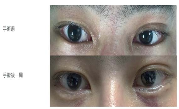 眼瞼內眥贅皮、眼瞼內翻 應經醫師評估手術治療