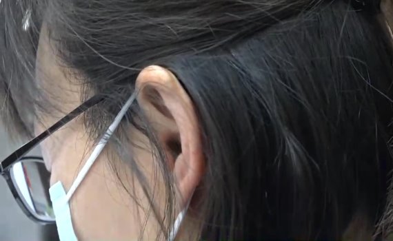 影/妙手回春!缺耳畫面怵目驚心 三次手術斷耳再造
