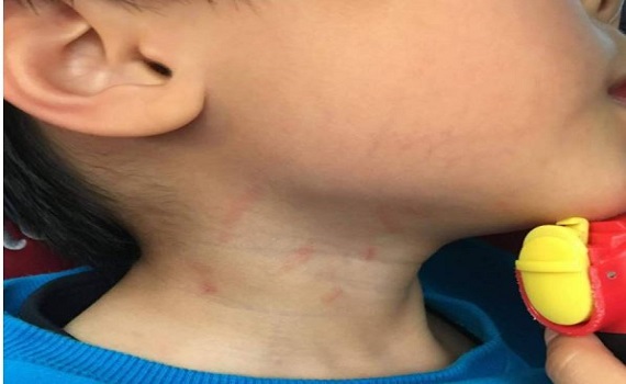 4歲幼童頸部被抓傷   幼兒園老師稱示範騷癢動作 