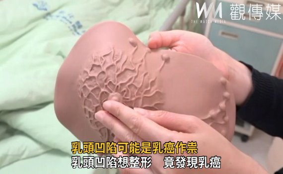 影／乳頭凹陷可能是乳癌作祟　婦女不能大意 