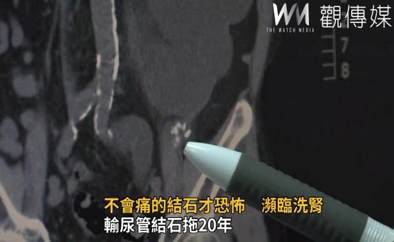 影/輸尿管結石拖20年 左腎大一倍已經壞掉