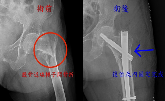 102歲人瑞跌倒骨折動彈不得 微創手術3天出院