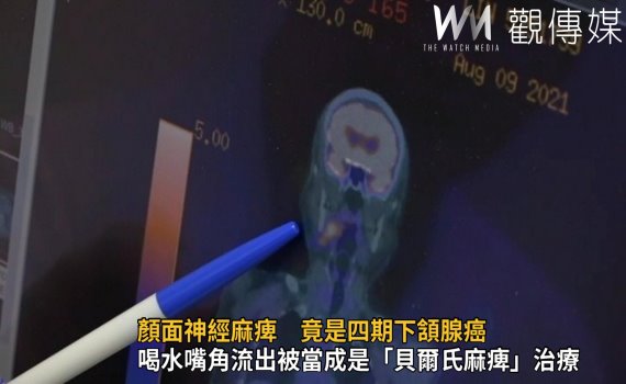 影/警訊疏忽不得 顏面神經麻痺竟是四期下頷腺癌