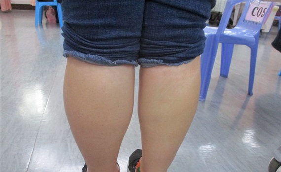 女子久坐左小腿腫脹 竟是深部靜脈栓塞導致