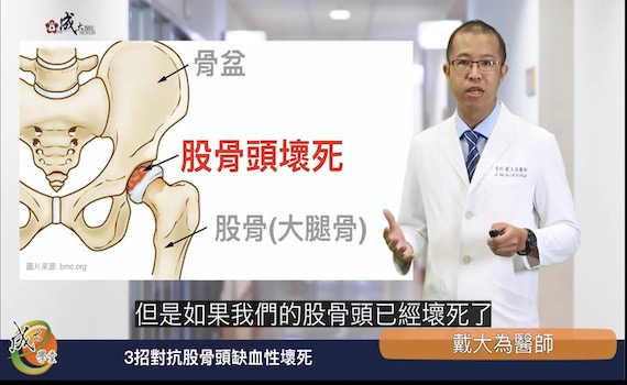 「骨壞死」患者福音 陶瓷人工關節「雙動式防脫臼」