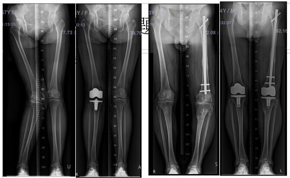 「微創人工膝關節置換手術」傷口更小　恢復快癒後佳 