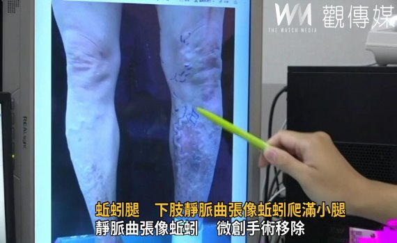 影/蚯蚓腿 下肢靜脈曲張像蚯蚓爬滿小腿嚴重將危及生命
