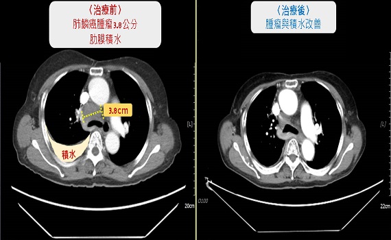 肺鱗癌非絕症 78歲嬤肺鱗癌四期積極治療恢復正常生活