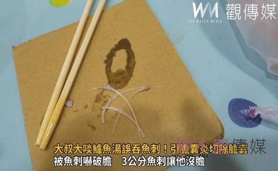 影/被魚刺嚇破膽!中年大叔大啖鱸魚湯誤吞魚刺!引膽囊炎切除膽囊