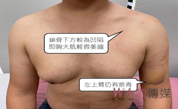 壯男健身「胸大肌」突斷裂    醫師：重訓要量力而為 