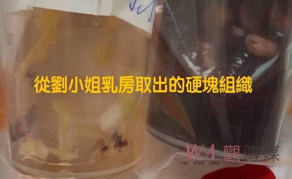 獨/台南妙齡女豐胸失敗恐切除雙乳 醫美名醫詹富盛挨告