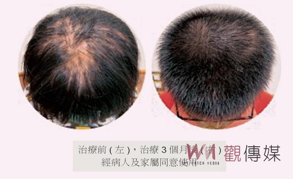 豆蔻女「鬼剃頭」 醫師提醒:一有症狀儘速就醫