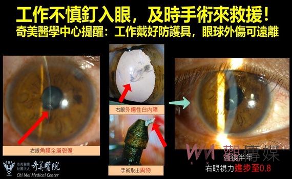 板模師傅遭釘子噴眼險失明 醫師警告:做好防護勿僥倖