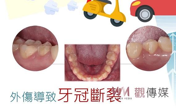 牙齒斷掉了！怎麼辦？　成大提供玻璃陶瓷嵌體修復