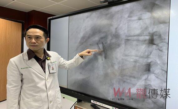 心臟問題竟也會造成腦梗塞   千萬別輕忽