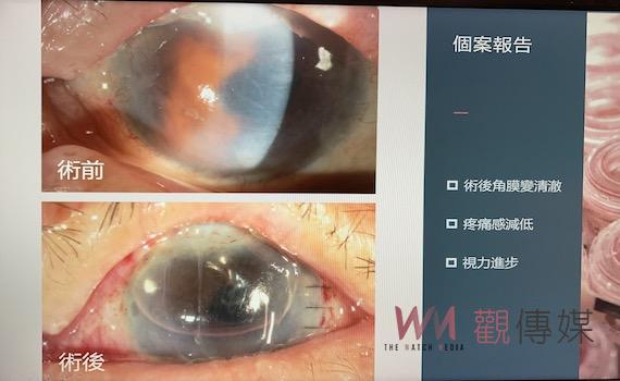 嘉義長庚引新型微創眼科手術　85翁重見光明感激溢言表