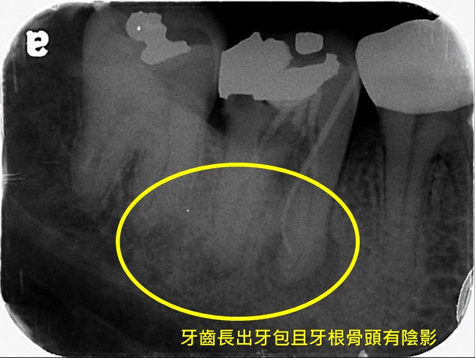 牙齒抽過神經就沒事？　1年後牙齦竟長這東西 - https://www.watchmedia01.com