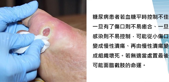 皮膚紅腫熱痛不可忽視　蜂窩性組織炎可能會截肢 - https://www.watchmedia01.com