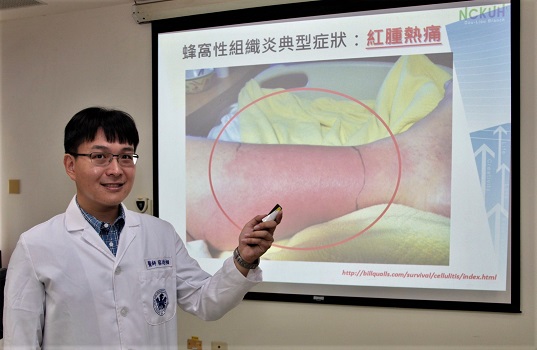 皮膚紅腫熱痛不可忽視　蜂窩性組織炎可能會截肢 - https://www.watchmedia01.com