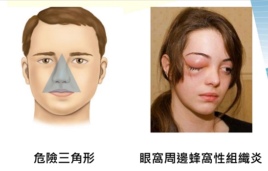 皮膚紅腫熱痛不可忽視　蜂窩性組織炎可能會截肢 - https://www.watchmedia01.com
