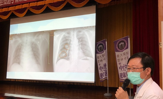 臺大雲林分院引進冷凍微針治療　肺腫瘤胸腔微創新進展 - https://www.watchmedia01.com
