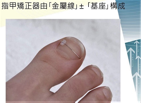 指甲矯正器治捲甲及嵌甲　是手術治療外的新方法 - https://www.watchmedia01.com