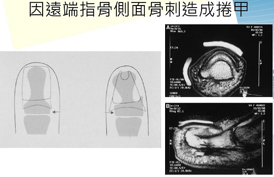 指甲矯正器治捲甲及嵌甲　是手術治療外的新方法 - https://www.watchmedia01.com