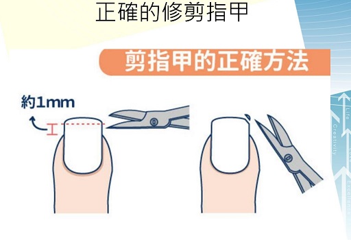 指甲矯正器治捲甲及嵌甲　是手術治療外的新方法 - https://www.watchmedia01.com