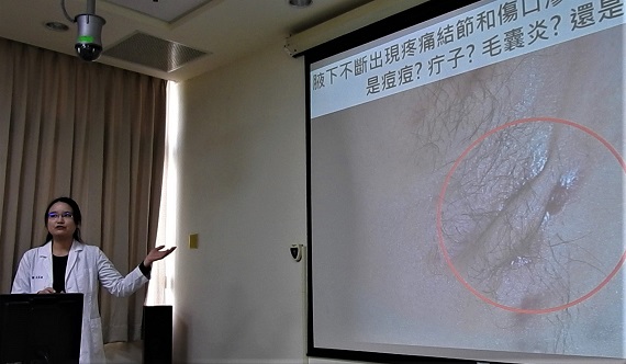腋窩臀部反覆腫痛長疔瘡　小心「化膿性汗腺炎」纏身 - https://www.watchmedia01.com