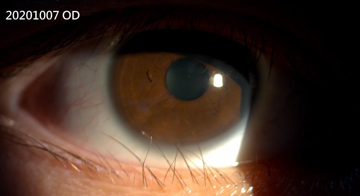 眼瞼內眥贅皮、眼瞼內翻　應經醫師評估手術治療 - https://www.watchmedia01.com