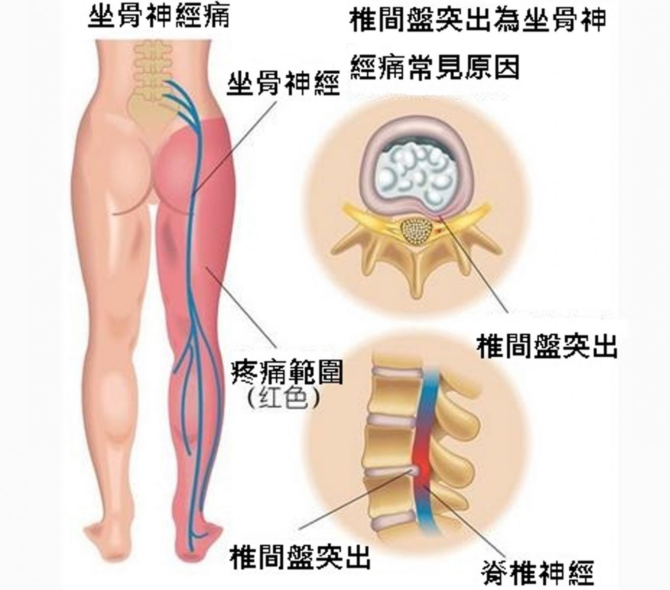 影／內視鏡微創治椎間盤突出　傷口小減少疼痛恢復快 - https://www.watchmedia01.com
