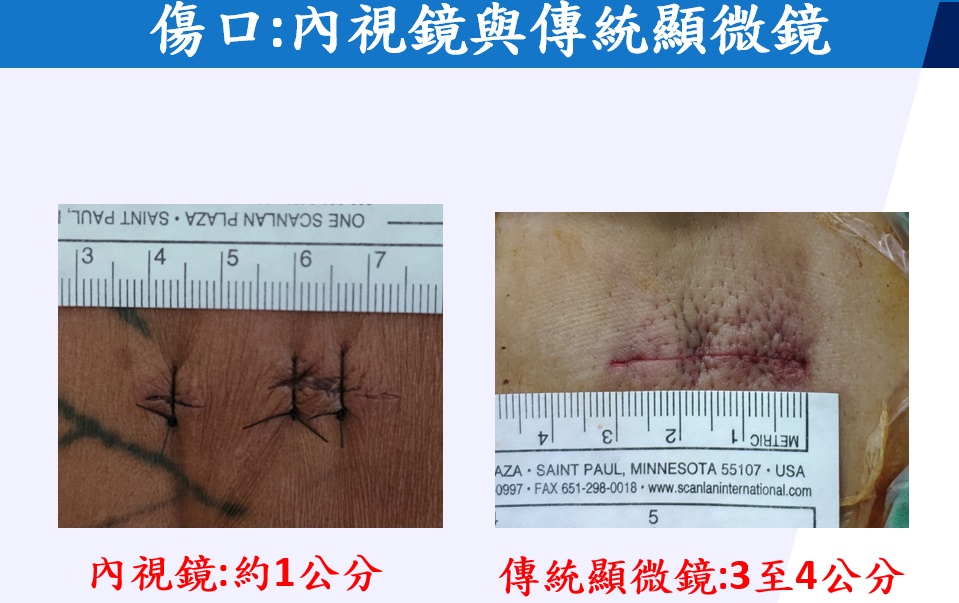影／內視鏡微創治椎間盤突出　傷口小減少疼痛恢復快 - https://www.watchmedia01.com