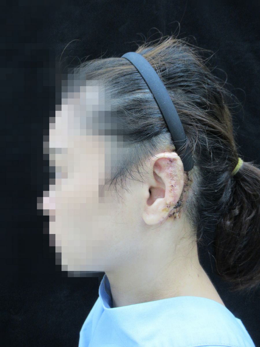 影／妙手回春！缺耳畫面怵目驚心　三次手術斷耳再造 - https://www.watchmedia01.com