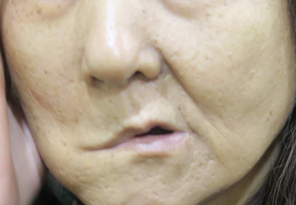 影／誤診顏面神經麻痺　嘴歪眼斜2年竟是腮腺癌 - https://www.watchmedia01.com