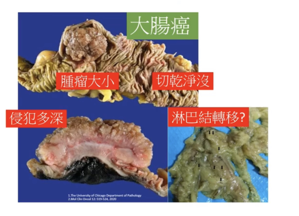 「病理報告」如同判決書 影響臨床治療方向 - https://www.watchmedia01.com