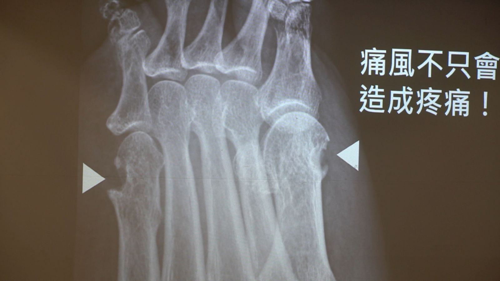 影／痛風不只傷關節也傷腎蛀骨　千萬不能忽視的現代文明病 - https://www.watchmedia01.com