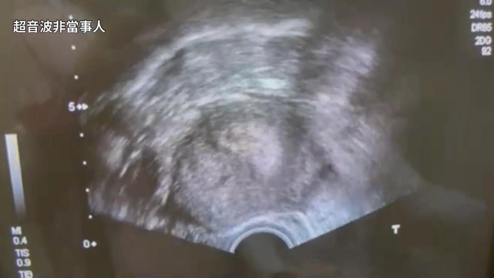影／疫情壞心情！懷孕婦女到婦產科要求「中止妊娠」 - https://www.watchmedia01.com