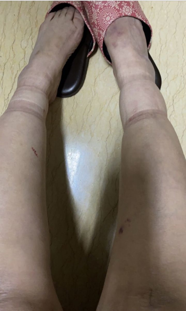 影／誤會大了！人妻手腳常瘀青　禍首是C肝 - https://www.watchmedia01.com