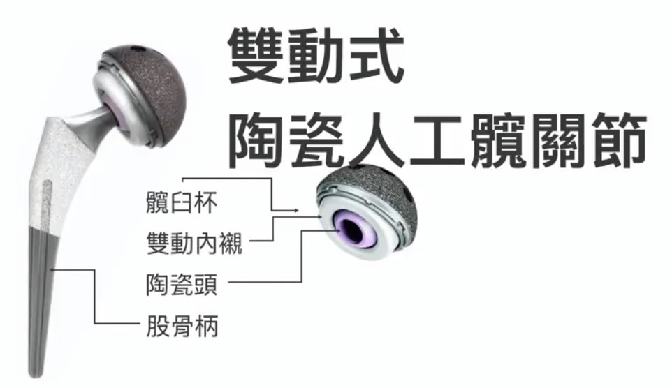 「骨壞死」患者福音 陶瓷人工關節「雙動式防脫臼」 - https://www.watchmedia01.com