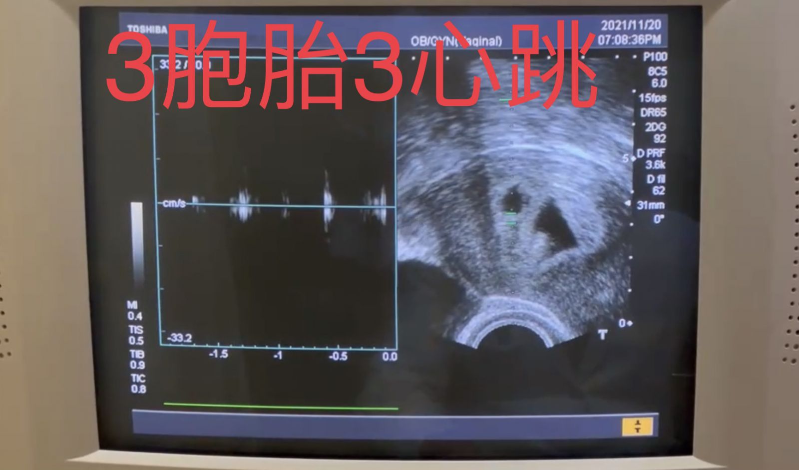 影／不孕透過試管嬰兒手術　適度紓壓一舉得三胞胎 - https://www.watchmedia01.com