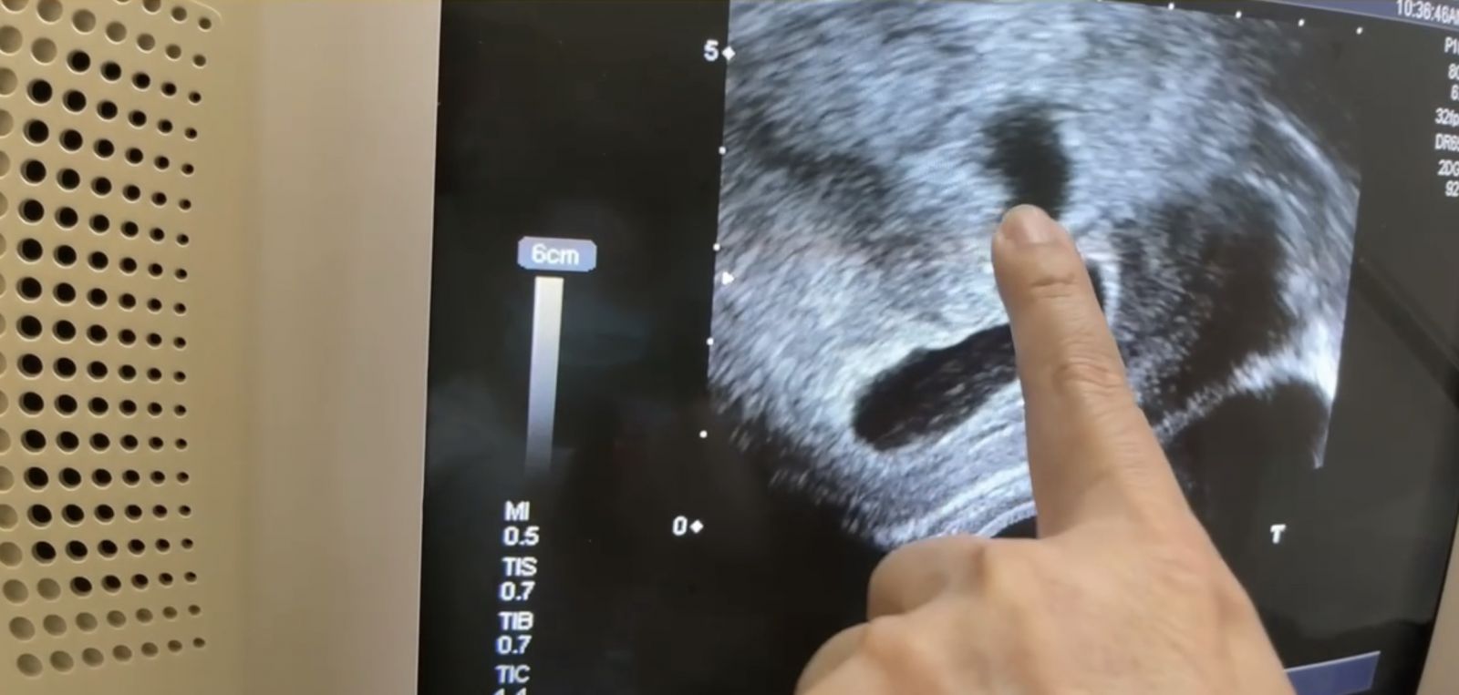 影／不孕透過試管嬰兒手術　適度紓壓一舉得三胞胎 - https://www.watchmedia01.com