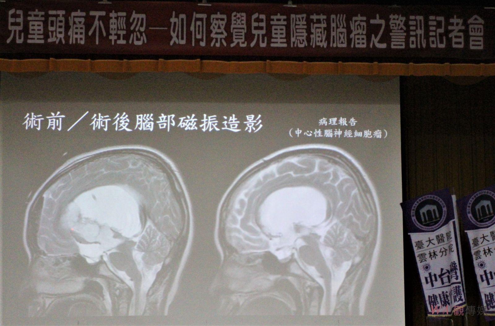 兒少頭痛疑急症警訊不輕忽 台大雲院提醒隱藏腦瘤警訊 - https://www.watchmedia01.com