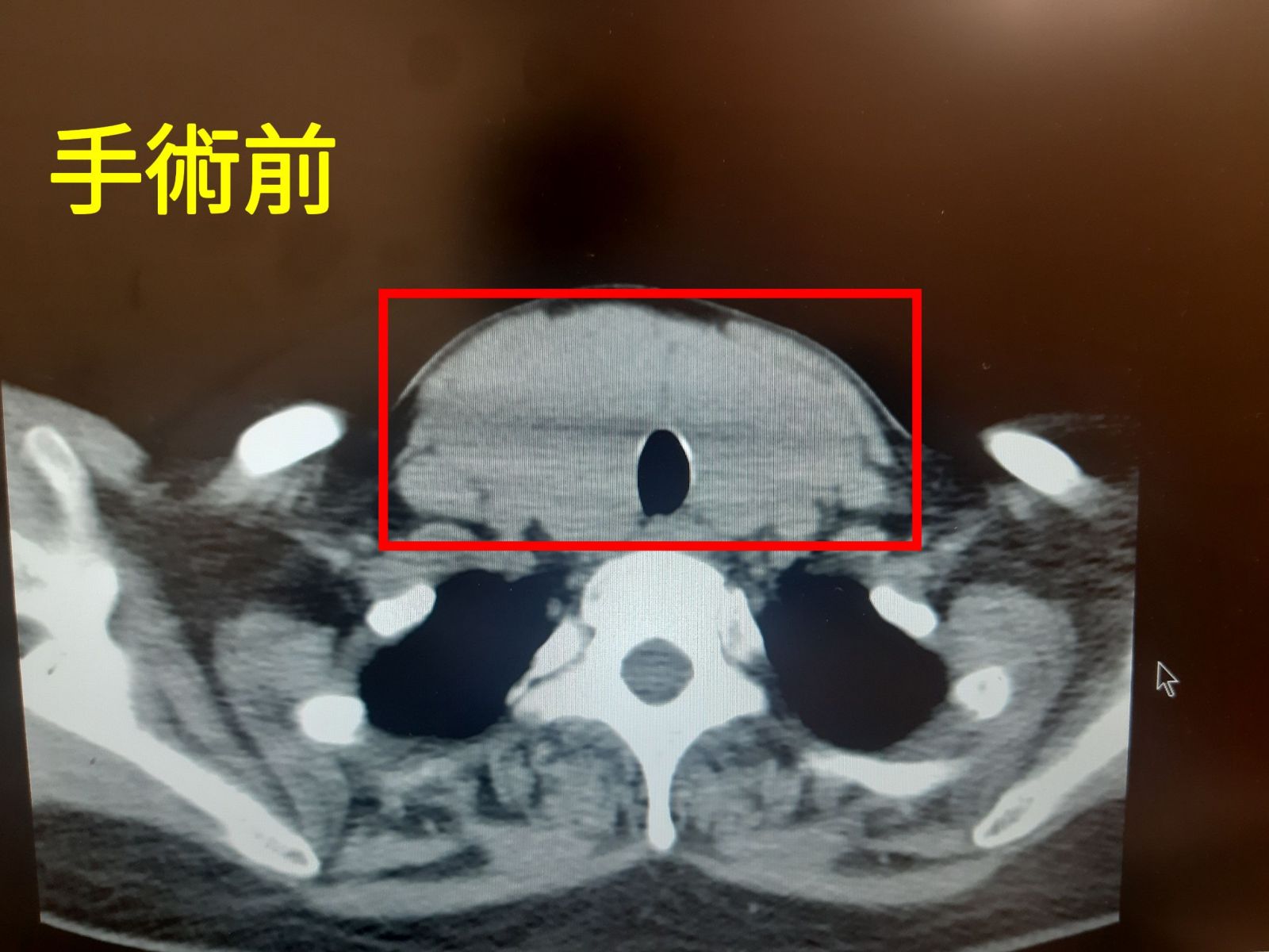 甲狀腺手術的罩門：精準定位的無痕微創甲狀腺切除手術 - https://www.watchmedia01.com
