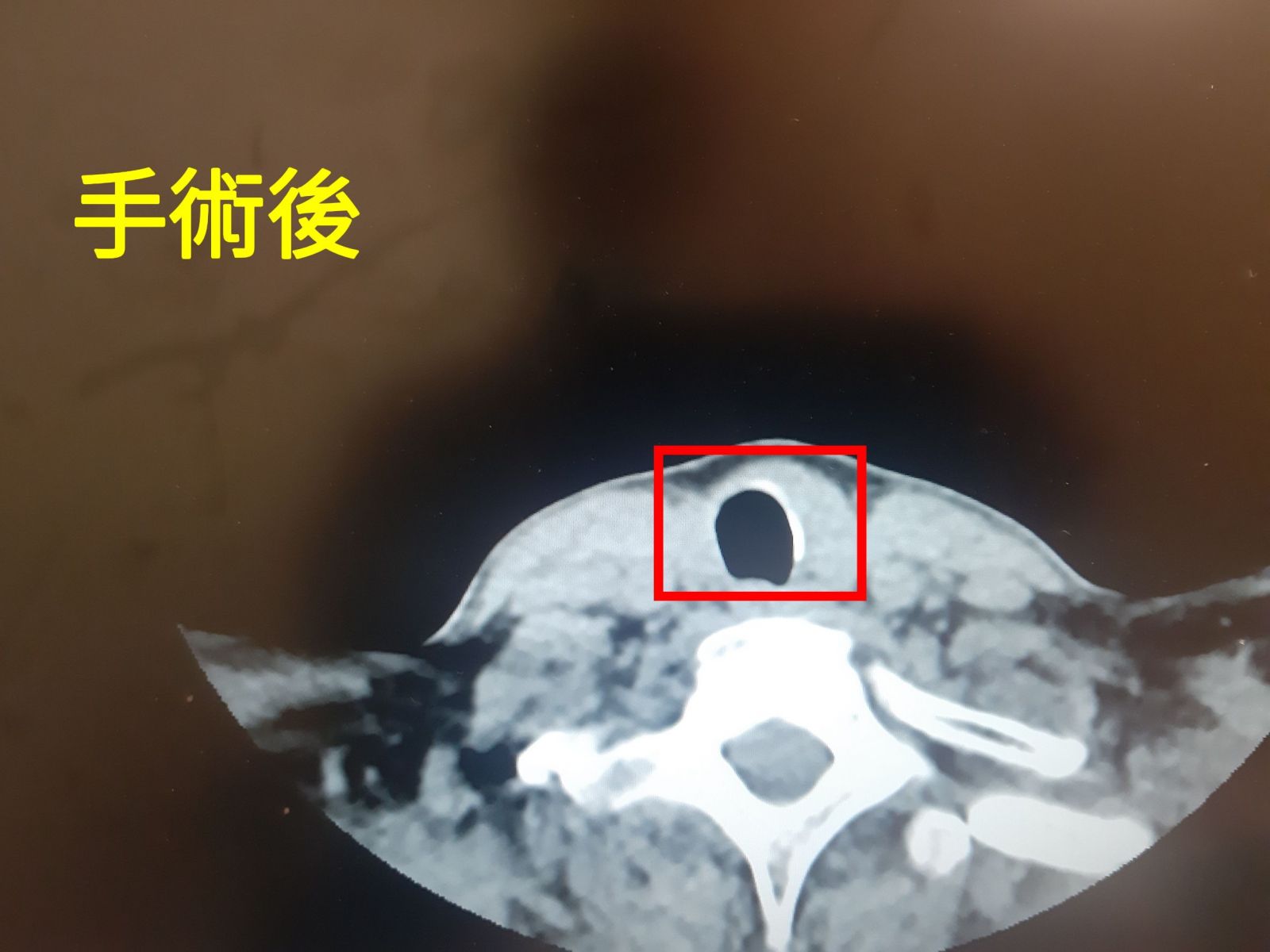 甲狀腺手術的罩門：精準定位的無痕微創甲狀腺切除手術 - https://www.watchmedia01.com