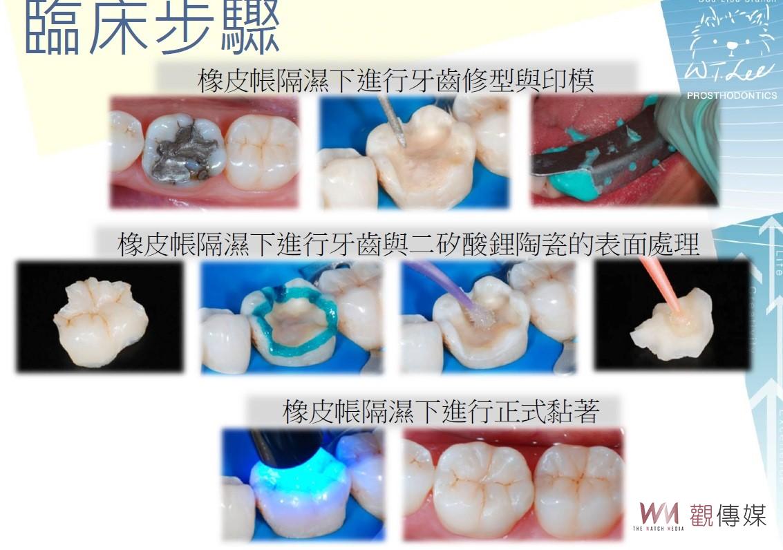 牙齒斷掉了！怎麼辦？　成大提供玻璃陶瓷嵌體修復 - https://www.watchmedia01.com