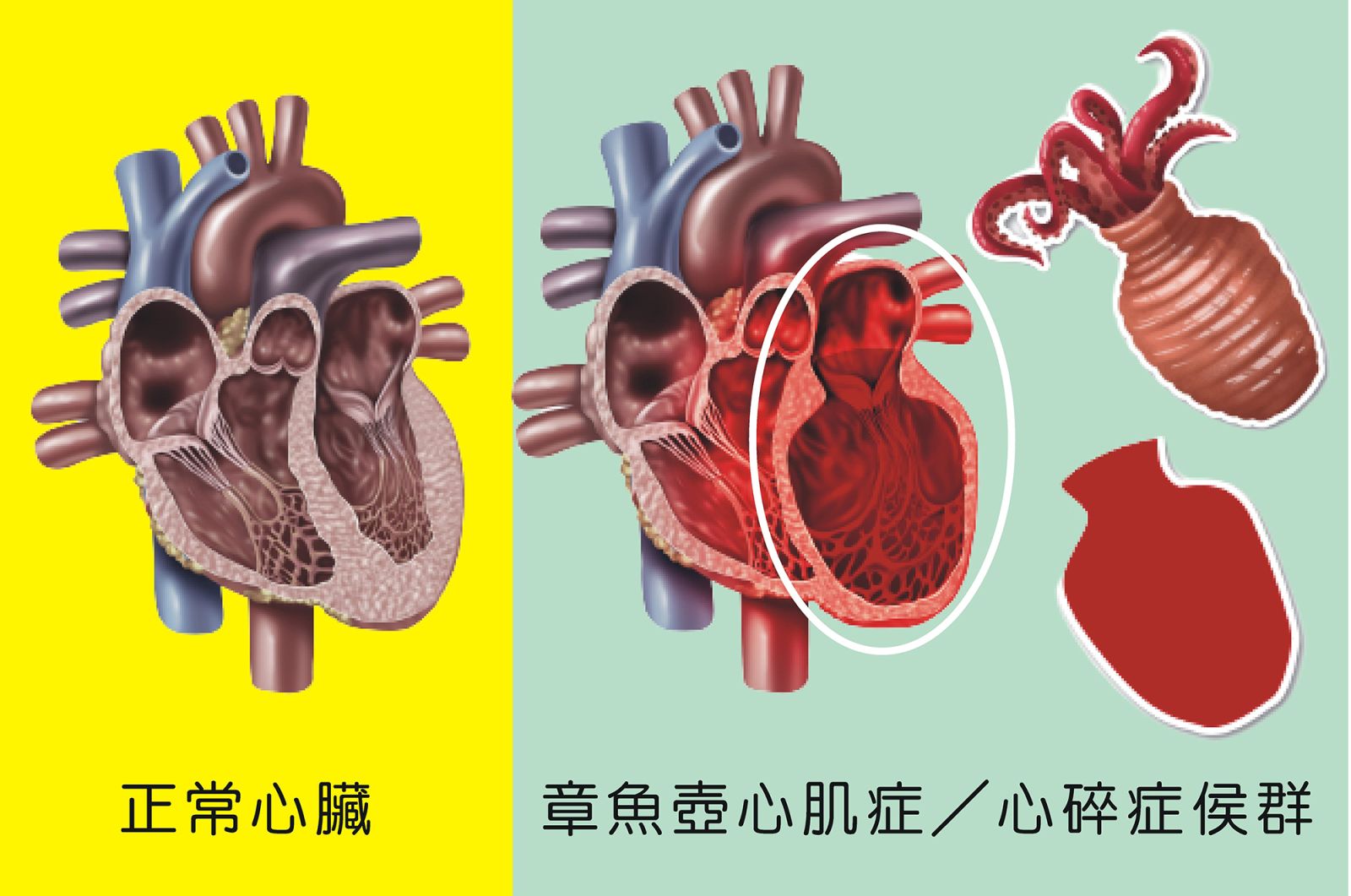 影／「心碎」會致命！　你不可不知道的心碎症候群 - https://www.watchmedia01.com